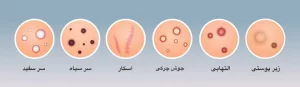 کرم آزلاییک اسید ۱۰ درصد