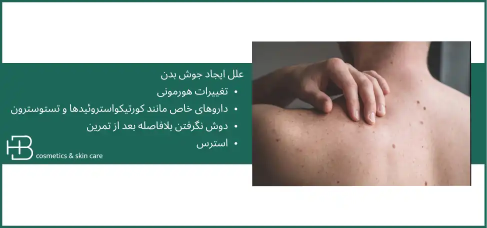از بین بردن جوش بدن